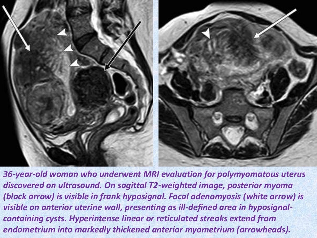 Presentation1.pptx, radiological imaging of endometriosis.