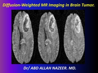 Diffusion-Weighted MR Imaging in Brain Tumor. 
Dr/ ABD ALLAH NAZEER. MD. 
 