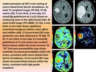Underestimation of CBV in the setting of 
severe blood-brain barrier breakdown. A) 
Axial T1-weighted image (TR 450, TE 20, 
matrix 256, 5-mm thick, 6-mm skip, 0.2 
mmol/Kg gadolinium at 5 cc/s) shows an 
enhancing mass in the right frontal lobe. B) 
Axial FLAIR image (TR 10000, TE 126, 5-mm 
thick, 6-mm skip) shows significant 
associated vasogenic edema, mass effect, 
and midline shift. C) Uncorrected CBV map 
(perfusion raw data obtained at TR 500, TE 
65, 5-mm thick, 6-mm skip, 0.2 mmol/Kg 
gadolinium at 5 cc/s) shows low cerebral 
blood volume within the lesion (arrow). D) 
“K2” first-pass permeability map shows 
markedly increased permeability within the 
lesion, consistent with severe blood-brain 
barrier breakdown. E) Corrected CBV map 
shows increased blood volume within the 
lesion, consistent with high-grade 
neoplasm. 
 