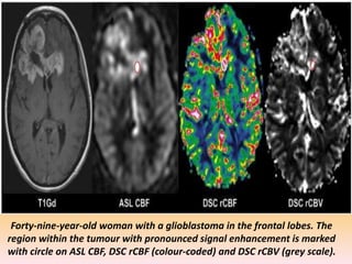 Forty-nine-year-old woman with a glioblastoma in the frontal lobes. The 
region within the tumour with pronounced signal enhancement is marked 
with circle on ASL CBF, DSC rCBF (colour-coded) and DSC rCBV (grey scale). 
 