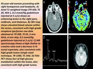 45-year-old woman presenting with 
right hemiparesis and headache. A) 
Axial T1-weighted image (TR 450, TE 
20, NEX 1, 0.2 mmol/Kg gadolinium 
injected at 5 cc/s) shows an 
enhancing lesion in the right pons, 
midbrain, and thalamus. B) CBV map 
shows elevated blood volume within 
the lesion, consistent with high-grade 
neoplasm (perfusion raw data 
obtained at TR 500, TE 65, 5-mm 
thick, 6-mm skip, 0.2 mmol/Kg 
gadolinium injected at 5 cc/s). C) MR 
spectroscopy shows a high choline to 
creatine ratio and a decrease in N-acetyl 
aspartate, also consistent with 
high-grade tumor (single voxel 
technique, TR 1500, TE 144). D) FDG-PET 
shows foci of high glucose 
metabolism within the lesion, also 
consistent with high-grade tumor. 
 