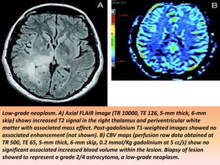 Low-grade neoplasm. A) Axial FLAIR image (TR 10000, TE 126, 5-mm thick, 6-mm 
skip) shows increased T2 signal in the right thalamus and periventricular white 
matter with associated mass effect. Post-gadolinium T1-weighted images showed no 
associated enhancement (not shown). B) CBV maps (perfusion raw data obtained at 
TR 500, TE 65, 5-mm thick, 6-mm skip, 0.2 mmol/Kg gadolinium at 5 cc/s) show no 
significant associated increased blood volume within the lesion. Biopsy of lesion 
showed to represent a grade 2/4 astrocytoma, a low-grade neoplasm. 
 