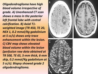 Oligodendroglioma have high 
blood volume irrespective of 
grade. A) Unenhanced CT scan 
shows a mass in the posterior 
left frontal lobe with central 
calcification. B) Axial T1- 
weighted image (TR 450, TE 20, 
NEX 1, 0.2 mmol/Kg gadolinium 
at 5 cc/s) shows only trace 
enhancement within the lesion. 
C) CBV map shows elevated 
blood volume within the lesion 
(perfusion raw data obtained at 
TR 500, TE 65, 5-mm thick, 6-mm 
skip, 0.2 mmol/Kg gadolinium at 
5 cc/s). Biopsy showed grade 2 
oligodendroglioma. 
 