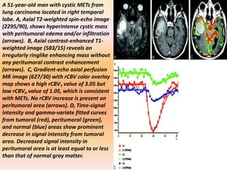 A 51-year-old man with cystic METs from 
lung carcinoma located in right temporal 
lobe. A, Axial T2-weighted spin-echo image 
(2295/90), shows hyperintense cystic mass 
with peritumoral edema and/or infiltration 
(arrows). B, Axial contrast-enhanced T1- 
weighted image (583/15) reveals an 
irregularly ringlike enhancing mass without 
any peritumoral contrast enhancement 
(arrows). C, Gradient-echo axial perfusion 
MR image (627/30) with rCBV color overlay 
map shows a high rCBVT value of 3.05 but 
low rCBVP value of 1.05, which is consistent 
with METs. No rCBV increase is present on 
peritumoral area (arrows). D, Time-signal 
intensity and gamma-variate fitted curves 
from tumoral (red), peritumoral (green), 
and normal (blue) areas show prominent 
decrease in signal intensity from tumoral 
area. Decreased signal intensity in 
peritumoral area is at least equal to or less 
than that of normal gray matter. 
 