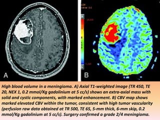 High blood volume in a meningioma. A) Axial T1-weighted image (TR 450, TE 
20, NEX 1, 0.2 mmol/Kg gadolinium at 5 cc/s) shows an extra-axial mass with 
solid and cystic components, with marked enhancement. B) CBV map shows 
marked elevated CBV within the tumor, consistent with high tumor vascularity 
(perfusion raw data obtained at TR 500, TE 65, 5-mm thick, 6-mm skip, 0.2 
mmol/Kg gadolinium at 5 cc/s). Surgery confirmed a grade 2/4 meningioma. 
 