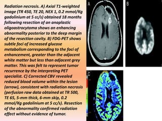 Radiation necrosis. A) Axial T1-weighted 
image (TR 450, TE 20, NEX 1, 0.2 mmol/Kg 
gadolinium at 5 cc/s) obtained 18 months 
following resection of an anaplastic 
oligoastrocytoma shows an enhancing 
abnormality posterior to the deep margin 
of the resection cavity. B) FDG-PET shows 
subtle foci of increased glucose 
metabolism corresponding to the foci of 
enhancement, greater than the adjacent 
white matter but less than adjacent grey 
matter. This was felt to represent tumor 
recurrence by the interpreting PET 
specialist. C) Corrected CBV revealed 
reduced blood volume within the lesion 
(arrow), consistent with radiation necrosis 
(perfusion raw data obtained at TR 500, 
TE 65, 5-mm thick, 6-mm skip, 0.2 
mmol/Kg gadolinium at 5 cc/s). Resection 
of the abnormality confirmed radiation 
effect without evidence of tumor. 
 