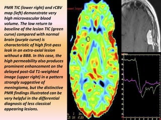 PMR TIC (lower right) and rCBV 
map (left) demonstrate very 
high microvascular blood 
volume. The low return to 
baseline of the lesion TIC (green 
curve) compared with normal 
brain (purple curve) is 
characteristic of high first-pass 
leak in an extra-axial lesion 
without a BBB. In this case, the 
high permeability also produces 
prominent enhancement on the 
delayed post-Gd T1-weighted 
image (upper right) in a pattern 
strongly suggestive of 
meningioma, but the distinctive 
PMR findings illustrated can be 
very helpful in the differential 
diagnosis of less classical 
appearing lesions. 
 