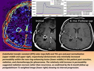 Endothelial transfer constant (KPS) color map (left) and TICs pre and post normalization 
(upper middle and upper right, respectively) demonstrate only minimally increased 
permeability within the new ring-enhancing lesion (lower middle) in this patient post resection, 
radiation, and chemotherapy for gliosarcoma. The relatively mild increase in permeability 
suggested radiation necrosis rather than recurrence, as confirmed by the 6-month follow-up 
postgadolinium T1-weighted image (lower right) showing no interval progression. 
 