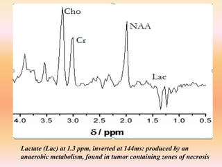 Lactate (Lac) at 1.3 ppm, inverted at 144ms: produced by an 
anaerobic metabolism, found in tumor containing zones of necrosis 
 