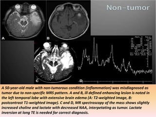 A 50-year-old male with non-tumorous condition (inflammation) was misdiagnosed as 
tumor due to non-specific MRS pattern. A and B, ill defined enhancing lesion is noted in 
the left temporal lobe with extensive brain edema (A: T2-weighted image, B: 
postcontrast T1-weighted image). C and D, MR spectroscopy of the mass shows slightly 
increased choline and lactate with decreased NAA, interpetating as tumor. Lactate 
inversion at long TE is needed for correct diagnosis. 
 
