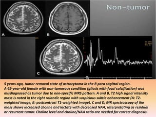 5 years ago, tumor removal state of astrocytoma in the R para sagittal region. 
A 49-year-old female with non-tumorous condition (gliosis with focal calcification) was 
misdiagnosed as tumor due to non-specific MRS pattern. A and B, T2 high signal intensity 
mass is noted in the right rolandic region with suspicious subtle enhancement (A: T2- 
weighted image, B: postcontrast T1-weighted image). C and D, MR spectroscopy of the 
mass shows increased choline and lactate with decreased NAA, interpretating as residual 
or recurrent tumor. Choline level and choline/NAA ratio are needed for correct diagnosis. 
 