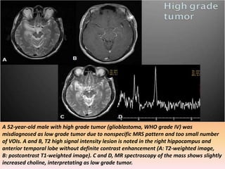 A 52-year-old male with high grade tumor (glioblastoma, WHO grade IV) was 
misdiagnosed as low grade tumor due to nonspecific MRS pattern and too small number 
of VOIs. A and B, T2 high signal intensity lesion is noted in the right hippocampus and 
anterior temporal lobe without definite contrast enhancement (A: T2-weighted image, 
B: postcontrast T1-weighted image). C and D, MR spectroscopy of the mass shows slightly 
increased choline, interpretating as low grade tumor. 
 