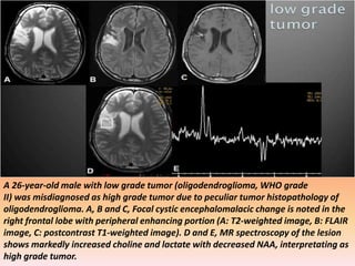 A 26-year-old male with low grade tumor (oligodendroglioma, WHO grade 
II) was misdiagnosed as high grade tumor due to peculiar tumor histopathology of 
oligodendroglioma. A, B and C, Focal cystic encephalomalacic change is noted in the 
right frontal lobe with peripheral enhancing portion (A: T2-weighted image, B: FLAIR 
image, C: postcontrast T1-weighted image). D and E, MR spectroscopy of the lesion 
shows markedly increased choline and lactate with decreased NAA, interpretating as 
high grade tumor. 
 