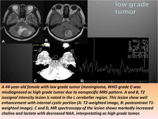 A 44-year-old female with low grade tumor (meningioma, WHO grade I) was 
misdiagnosed as high grade tumor due to nonspecific MRS pattern. A and B, T2 
isosignal intensity lesion is noted in the L cerebellar region. This lesion show well 
enhancement with internal cystic portion (A: T2-weighted image, B: postcontrast T1- 
weighted image). C and D, MR spectroscopy of the lesion shows markedly increased 
choline and lactate with decreased NAA, interpretating as high grade tumor. 
 