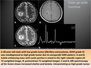 A 48-year-old male with low grade tumor (fibrillary astrocytoma, WHO grade II) 
was misdiagnosed as high grade tumor due to nonspecific MRS pattern. A and B, 
Subtle enhancing mass with cystic portion is noted in the right rolandic region (A: 
T2-weighted image, B: postcontrast T1-weighted image). C and D, MR spectroscopy 
of the lesion shows increased choline and lactate, interpretating as high grade tumor. 
 