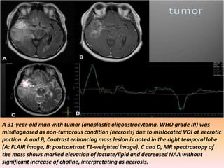 A 31-year-old man with tumor (anaplastic oligoastrocytoma, WHO grade III) was 
misdiagnosed as non-tumorous condition (necrosis) due to mislocated VOI at necrotic 
portion. A and B, Contrast enhancing mass lesion is noted in the right temporal lobe 
(A: FLAIR image, B: postcontrast T1-weighted image). C and D, MR spectroscopy of 
the mass shows marked elevation of lactate/lipid and decreased NAA without 
significant increase of choline, interpretating as necrosis. 
 