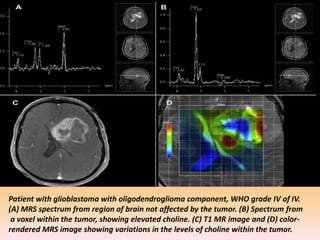 Patient with glioblastoma with oligodendroglioma component, WHO grade IV of IV. 
(A) MRS spectrum from region of brain not affected by the tumor. (B) Spectrum from 
a voxel within the tumor, showing elevated choline. (C) T1 MR image and (D) color-rendered 
MRS image showing variations in the levels of choline within the tumor. 
 