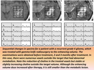 Sequential changes in spectra for a patient with a recurrent grade 4 glioma, which 
was treated with gamma knife radiosurgery to the enhancing volume. The 
examinations were obtained before treatment, 2 and 3 months after treatment. In 
this case, there were numerous voxels outside the target that had abnormal 
metabolism. Note the reduction of choline in the treated voxels but stable or 
slightly increasing choline outside the target volume. Although the enhancing 
volume dose increased after therapy, it is still smaller than the metabolic lesion. 
 