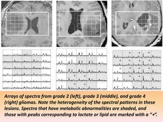 Arrays of spectra from grade 2 (left), grade 3 (middle), and grade 4 
(right) gliomas. Note the heterogeneity of the spectral patterns in these 
lesions. Spectra that have metabolic abnormalities are shaded, and 
those with peaks corresponding to lactate or lipid are marked with a “∗”. 
 