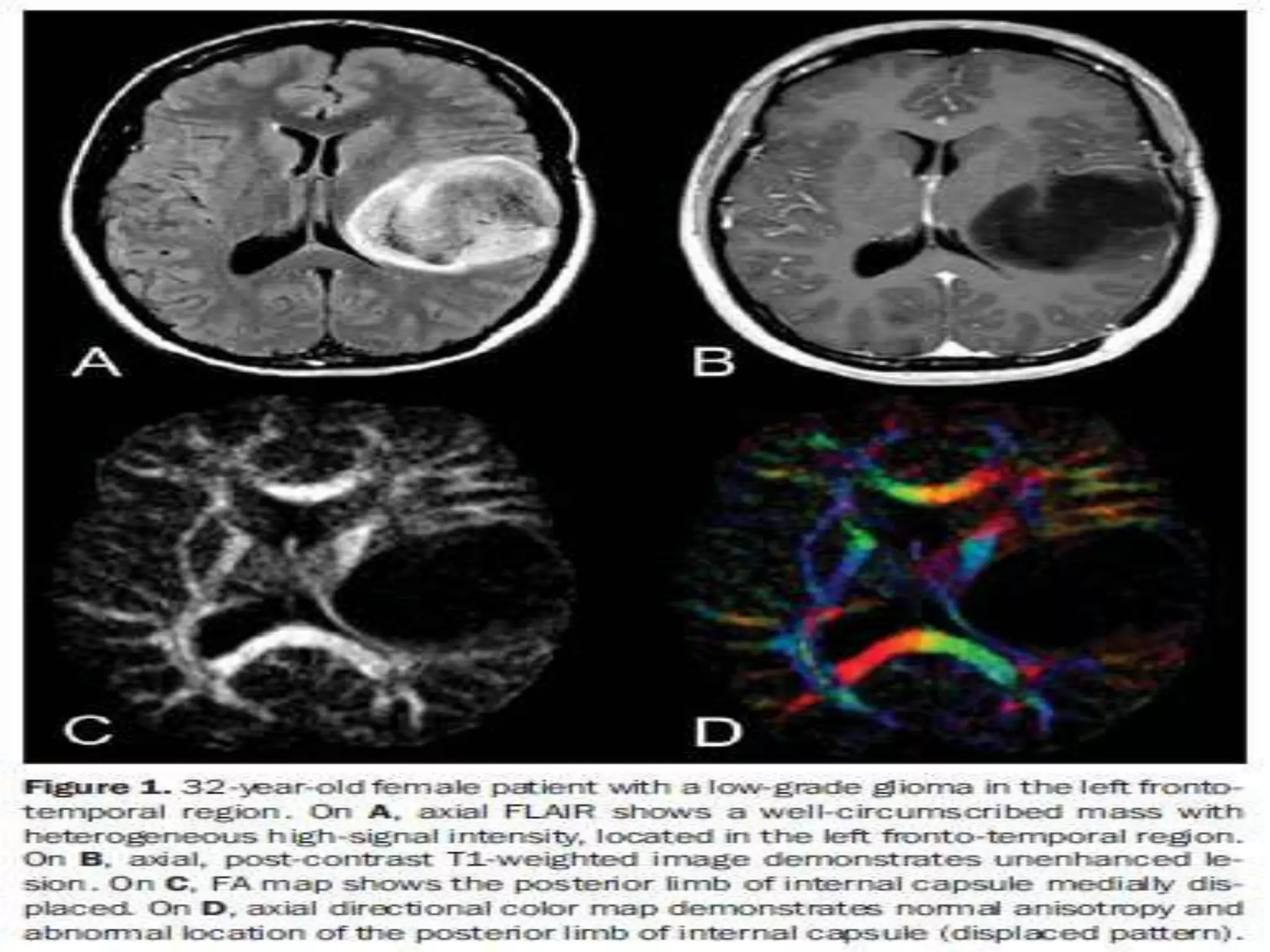 Presentation1.pptx, diffusion tensor imaging of white matter tract in ...