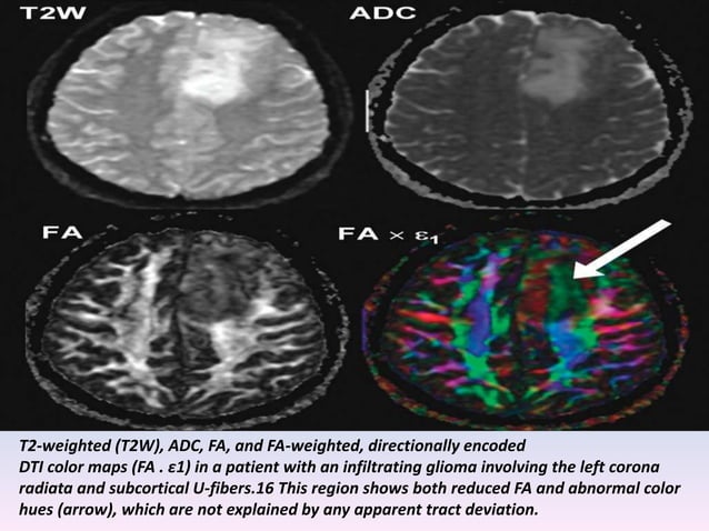 Presentation1.pptx, diffusion tensor imaging of white matter tract in ...