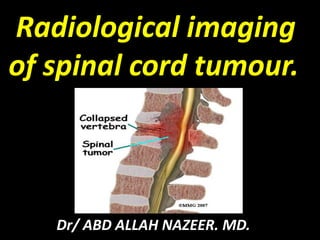 Radiological imaging 
of spinal cord tumour. 
Dr/ ABD ALLAH NAZEER. MD. 
 