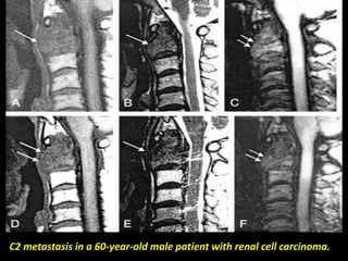 Presentation1.pptx, radiological imaging of spinal cord tumour. | PPTX