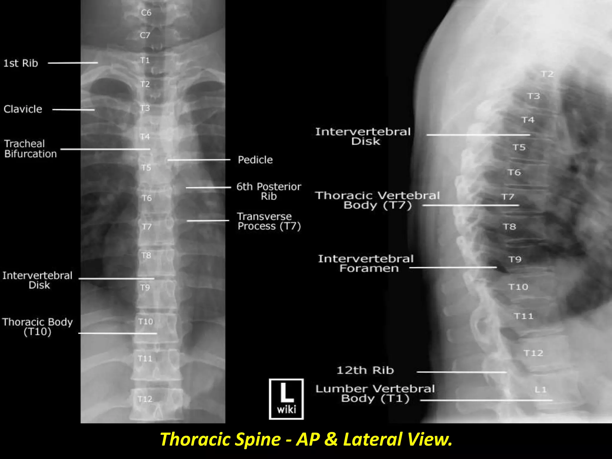 Thoracic Spine - AP & Lateral View. 
 
