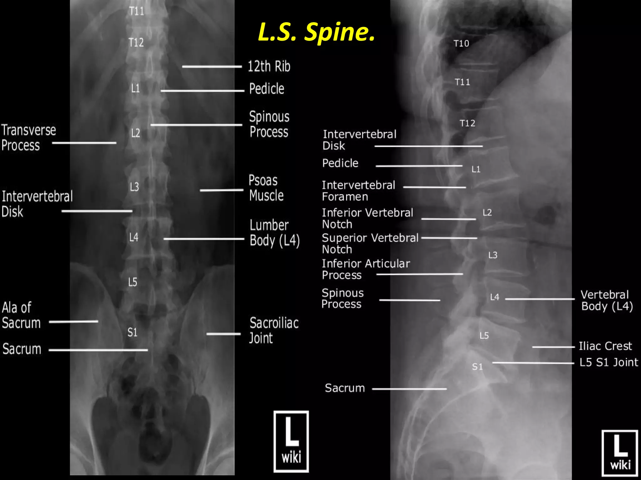 L.S. Spine. 
 