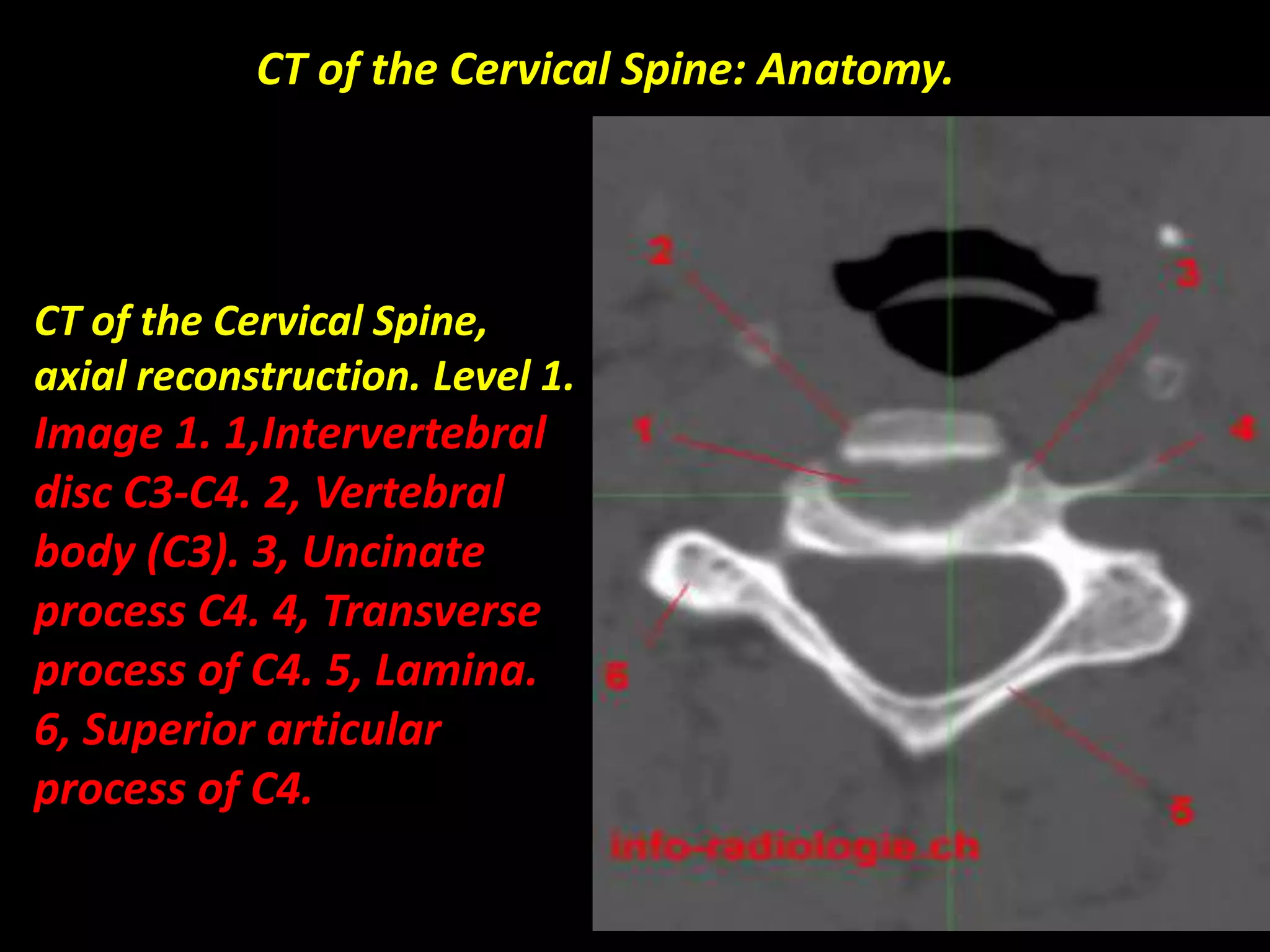 CT of the Cervical Spine: Anatomy. 
CT of the Cervical Spine, 
axial reconstruction. Level 1. 
Image 1. 1,Intervertebral 
disc C3-C4. 2, Vertebral 
body (C3). 3, Uncinate 
process C4. 4, Transverse 
process of C4. 5, Lamina. 
6, Superior articular 
process of C4. 
 