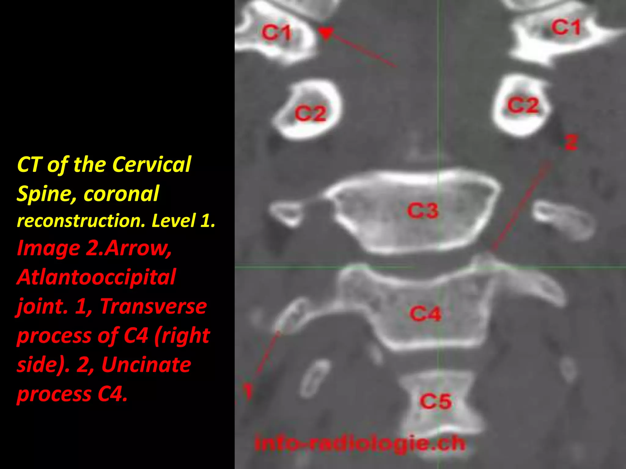 CT of the Cervical 
Spine, coronal 
reconstruction. Level 1. 
Image 2.Arrow, 
Atlantooccipital 
joint. 1, Transverse 
process of C4 (right 
side). 2, Uncinate 
process C4. 
 