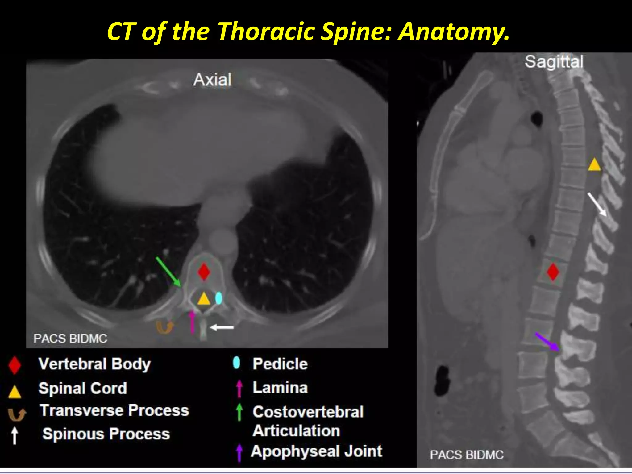 CT of the Thoracic Spine: Anatomy. 
 