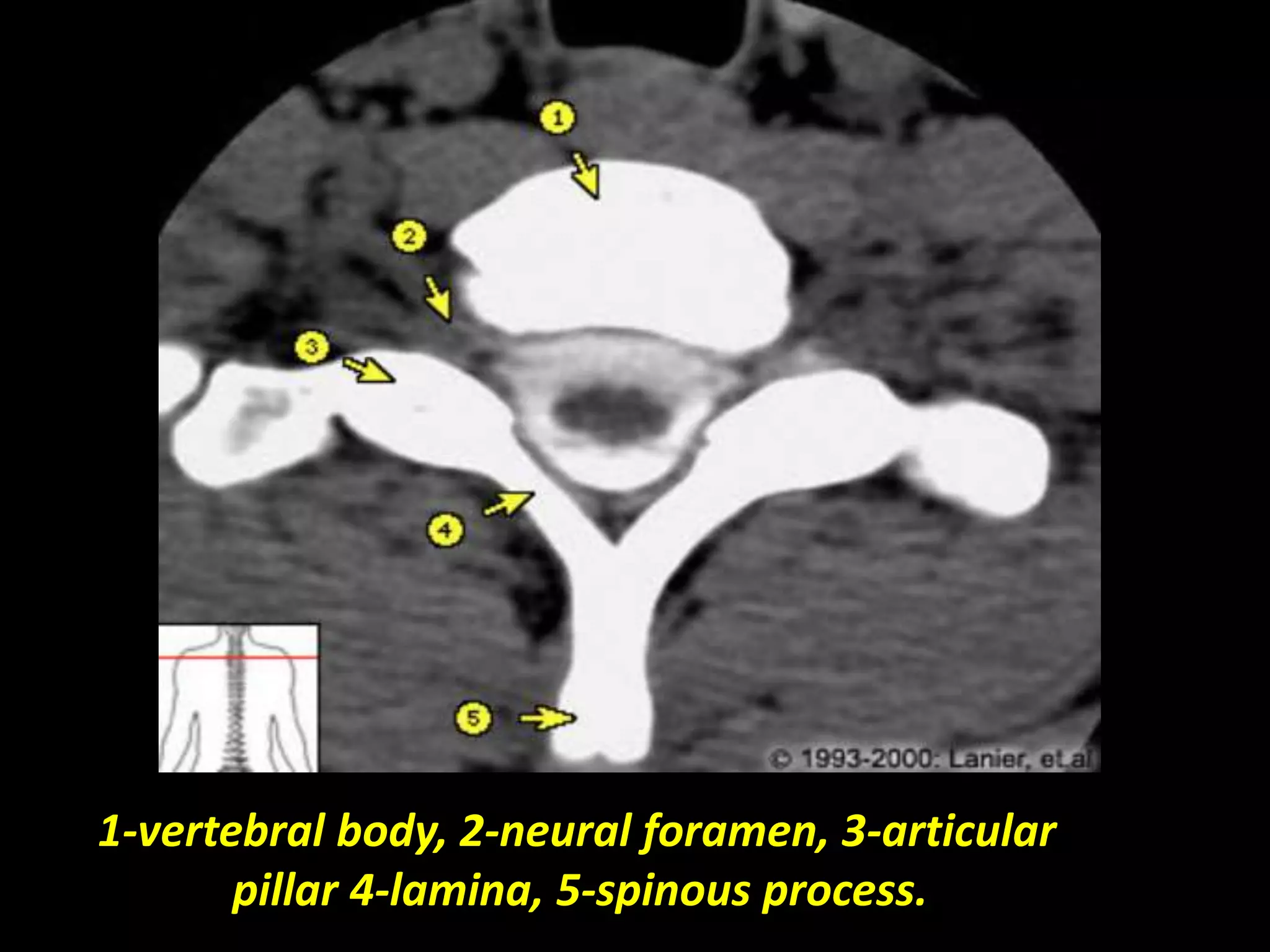 1-vertebral body, 2-neural foramen, 3-articular 
pillar 4-lamina, 5-spinous process. 
 