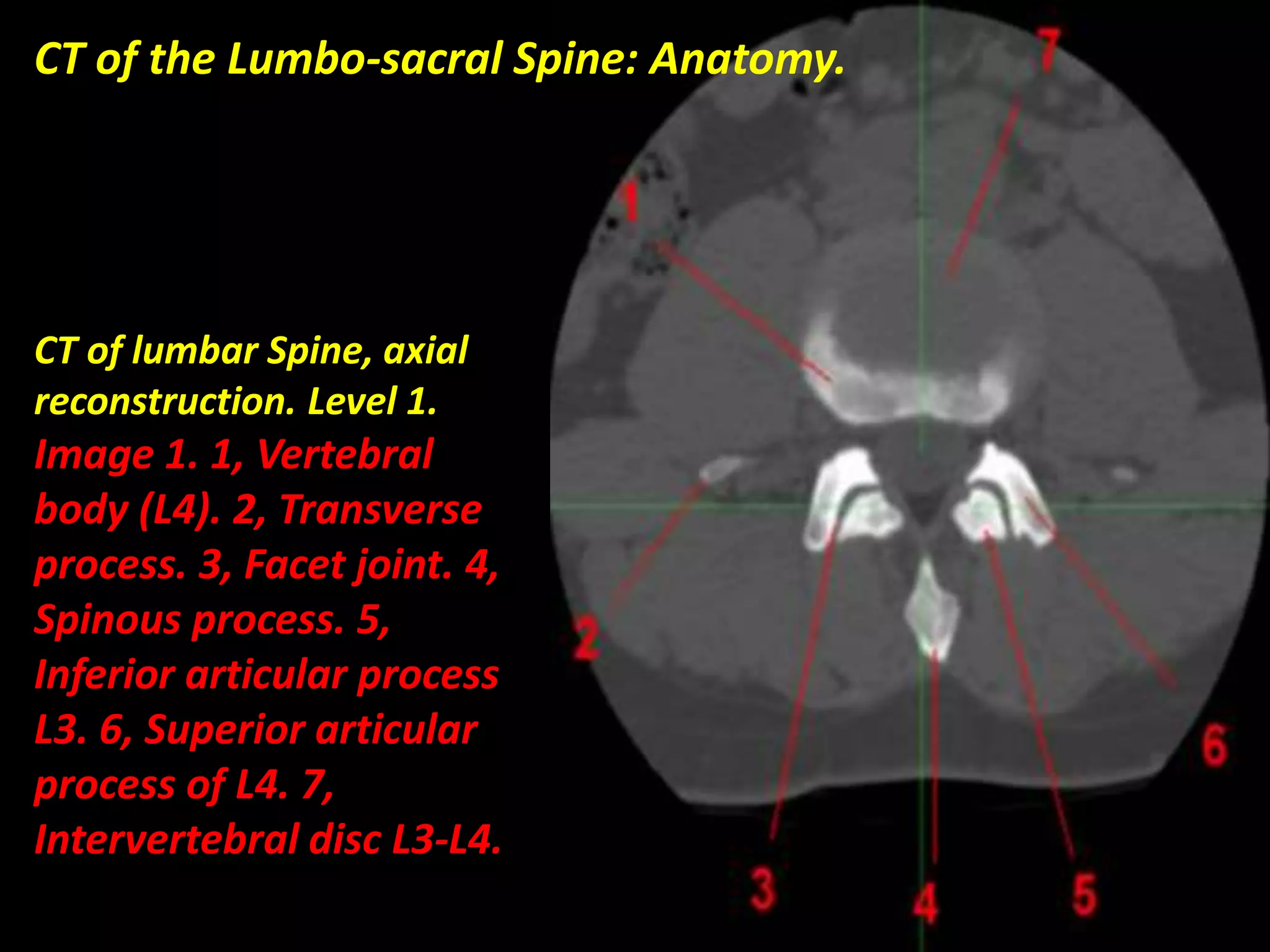 CT of the Lumbo-sacral Spine: Anatomy. 
CT of lumbar Spine, axial 
reconstruction. Level 1. 
Image 1. 1, Vertebral 
body (L4). 2, Transverse 
process. 3, Facet joint. 4, 
Spinous process. 5, 
Inferior articular process 
L3. 6, Superior articular 
process of L4. 7, 
Intervertebral disc L3-L4. 
 