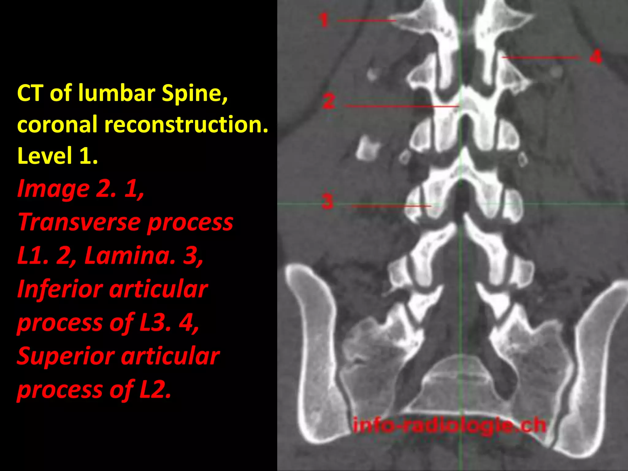 CT of lumbar Spine, 
coronal reconstruction. 
Level 1. 
Image 2. 1, 
Transverse process 
L1. 2, Lamina. 3, 
Inferior articular 
process of L3. 4, 
Superior articular 
process of L2. 
 