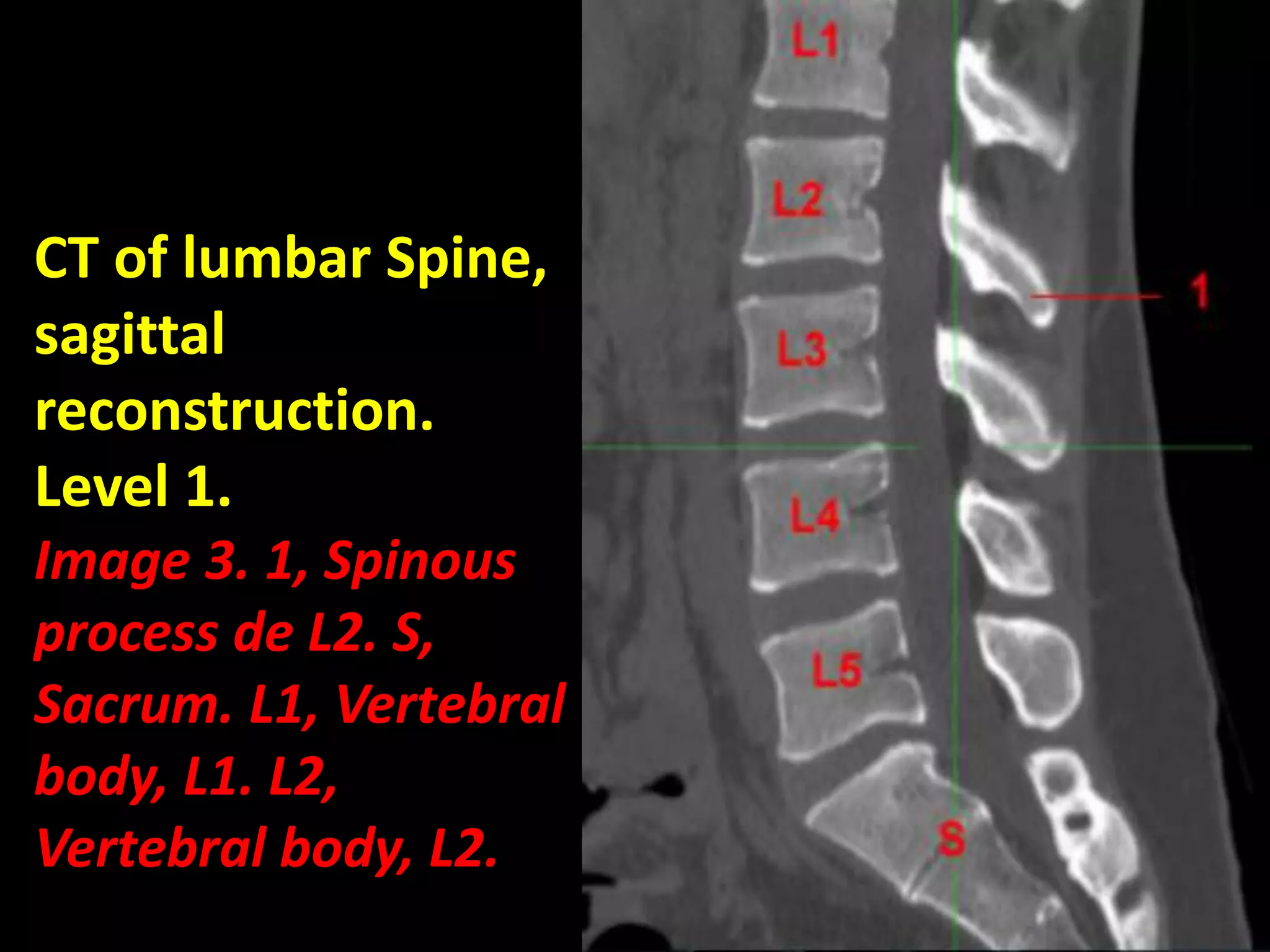 CT of lumbar Spine, 
sagittal 
reconstruction. 
Level 1. 
Image 3. 1, Spinous 
process de L2. S, 
Sacrum. L1, Vertebral 
body, L1. L2, 
Vertebral body, L2. 
 