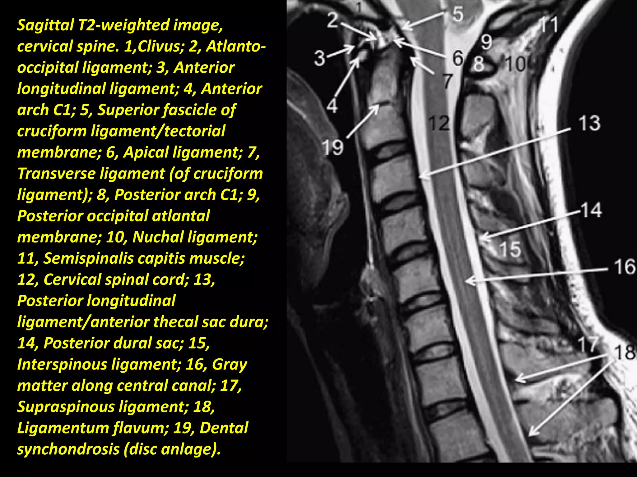 Sagittal T2-weighted image, 
cervical spine. 1,Clivus; 2, Atlanto-occipital 
ligament; 3, Anterior 
longitudinal ligament; 4, Anterior 
arch C1; 5, Superior fascicle of 
cruciform ligament/tectorial 
membrane; 6, Apical ligament; 7, 
Transverse ligament (of cruciform 
ligament); 8, Posterior arch C1; 9, 
Posterior occipital atlantal 
membrane; 10, Nuchal ligament; 
11, Semispinalis capitis muscle; 
12, Cervical spinal cord; 13, 
Posterior longitudinal 
ligament/anterior thecal sac dura; 
14, Posterior dural sac; 15, 
Interspinous ligament; 16, Gray 
matter along central canal; 17, 
Supraspinous ligament; 18, 
Ligamentum flavum; 19, Dental 
synchondrosis (disc anlage). 
 