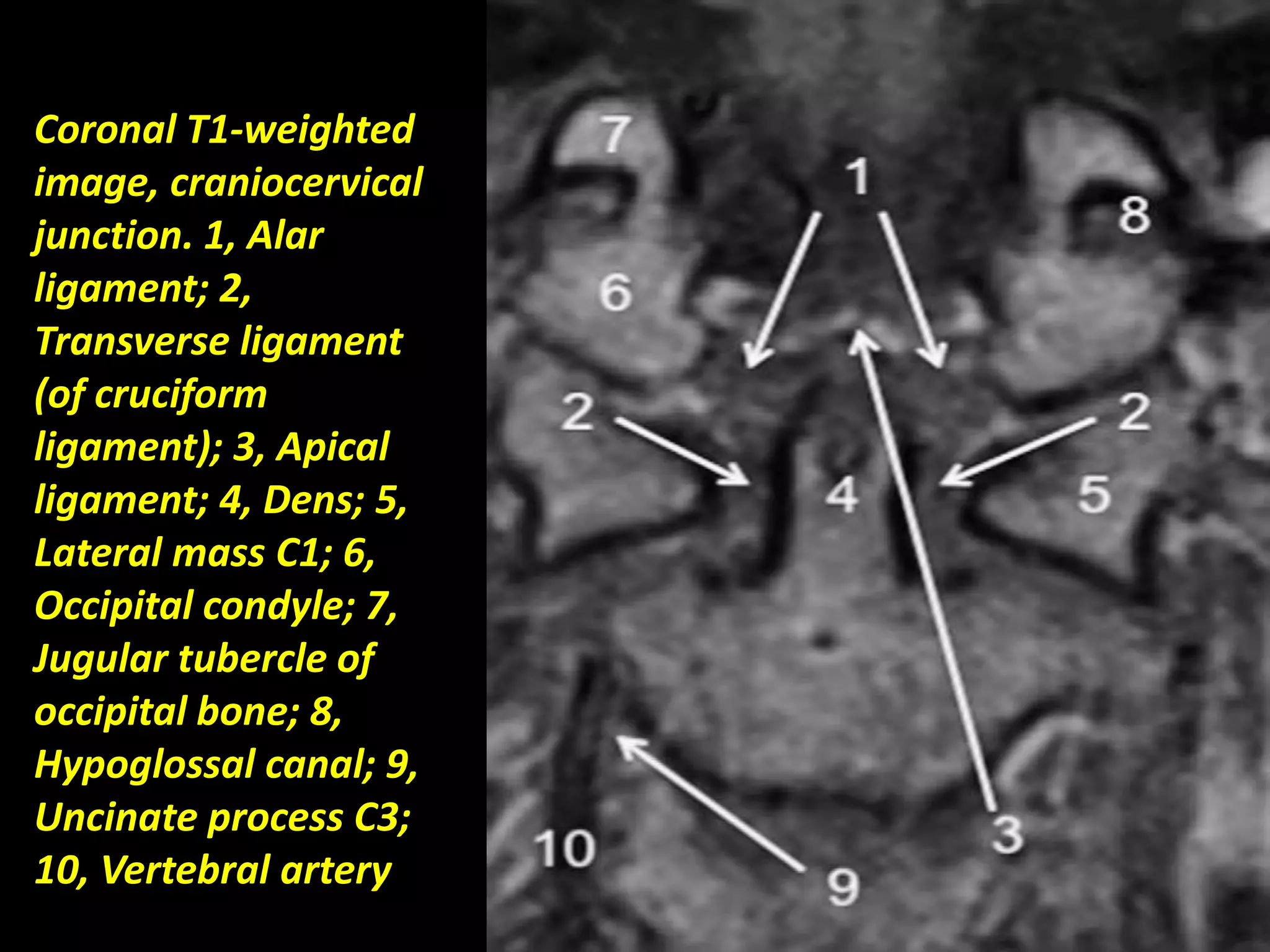 Coronal T1-weighted 
image, craniocervical 
junction. 1, Alar 
ligament; 2, 
Transverse ligament 
(of cruciform 
ligament); 3, Apical 
ligament; 4, Dens; 5, 
Lateral mass C1; 6, 
Occipital condyle; 7, 
Jugular tubercle of 
occipital bone; 8, 
Hypoglossal canal; 9, 
Uncinate process C3; 
10, Vertebral artery. 
 