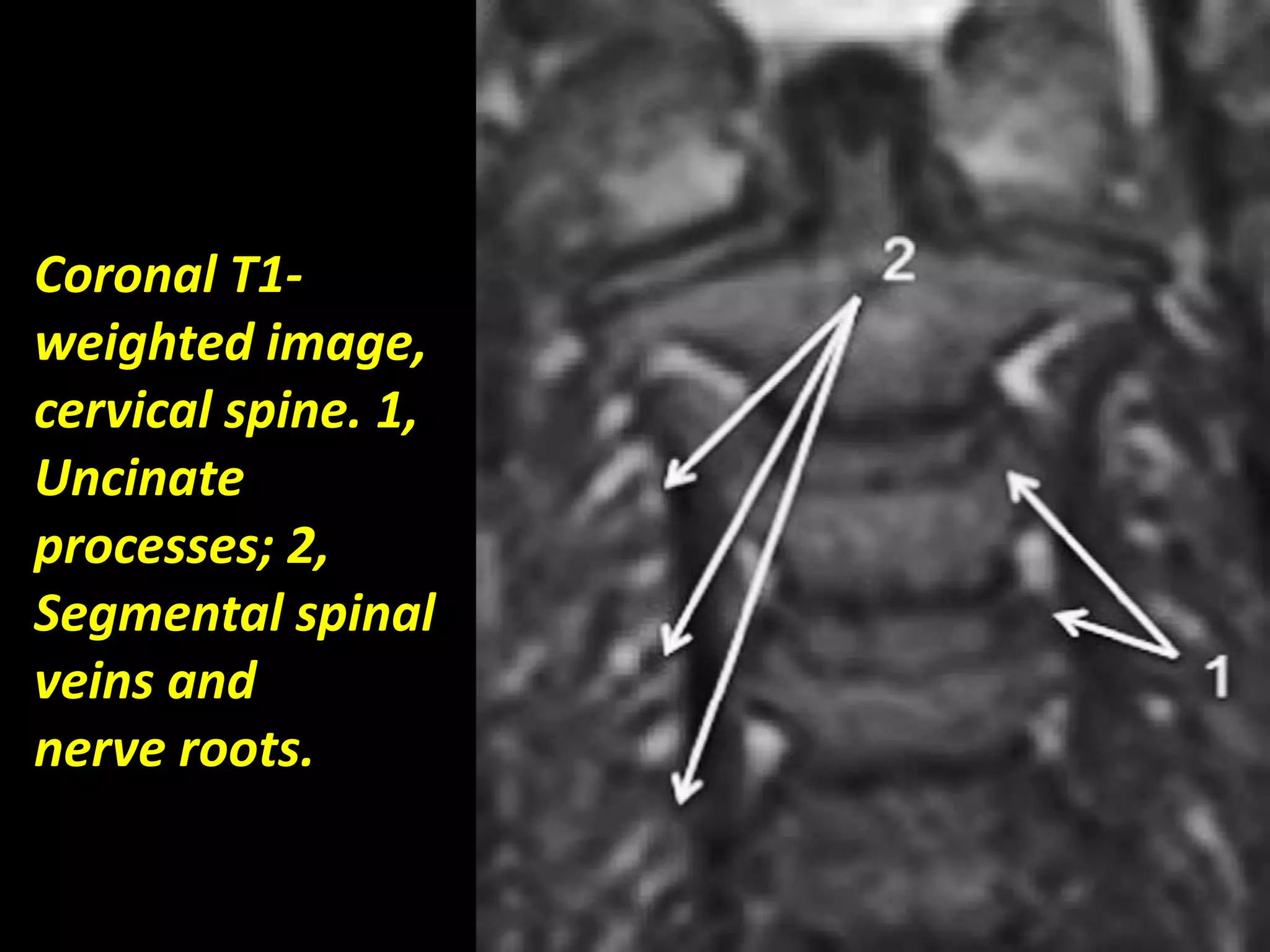 Coronal T1- 
weighted image, 
cervical spine. 1, 
Uncinate 
processes; 2, 
Segmental spinal 
veins and 
nerve roots. 
 