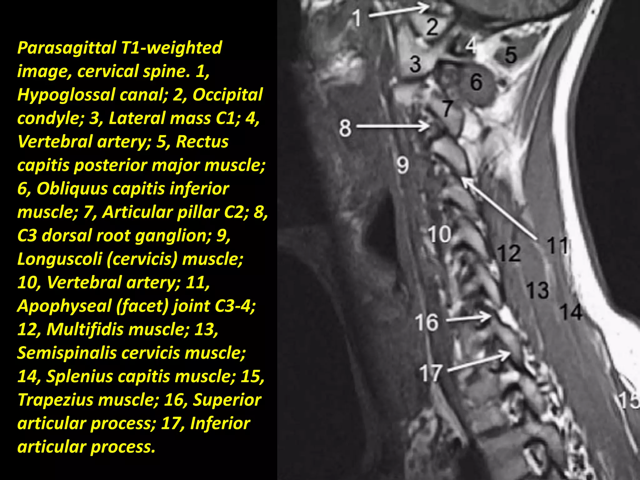 Parasagittal T1-weighted 
image, cervical spine. 1, 
Hypoglossal canal; 2, Occipital 
condyle; 3, Lateral mass C1; 4, 
Vertebral artery; 5, Rectus 
capitis posterior major muscle; 
6, Obliquus capitis inferior 
muscle; 7, Articular pillar C2; 8, 
C3 dorsal root ganglion; 9, 
Longuscoli (cervicis) muscle; 
10, Vertebral artery; 11, 
Apophyseal (facet) joint C3-4; 
12, Multifidis muscle; 13, 
Semispinalis cervicis muscle; 
14, Splenius capitis muscle; 15, 
Trapezius muscle; 16, Superior 
articular process; 17, Inferior 
articular process. 
 