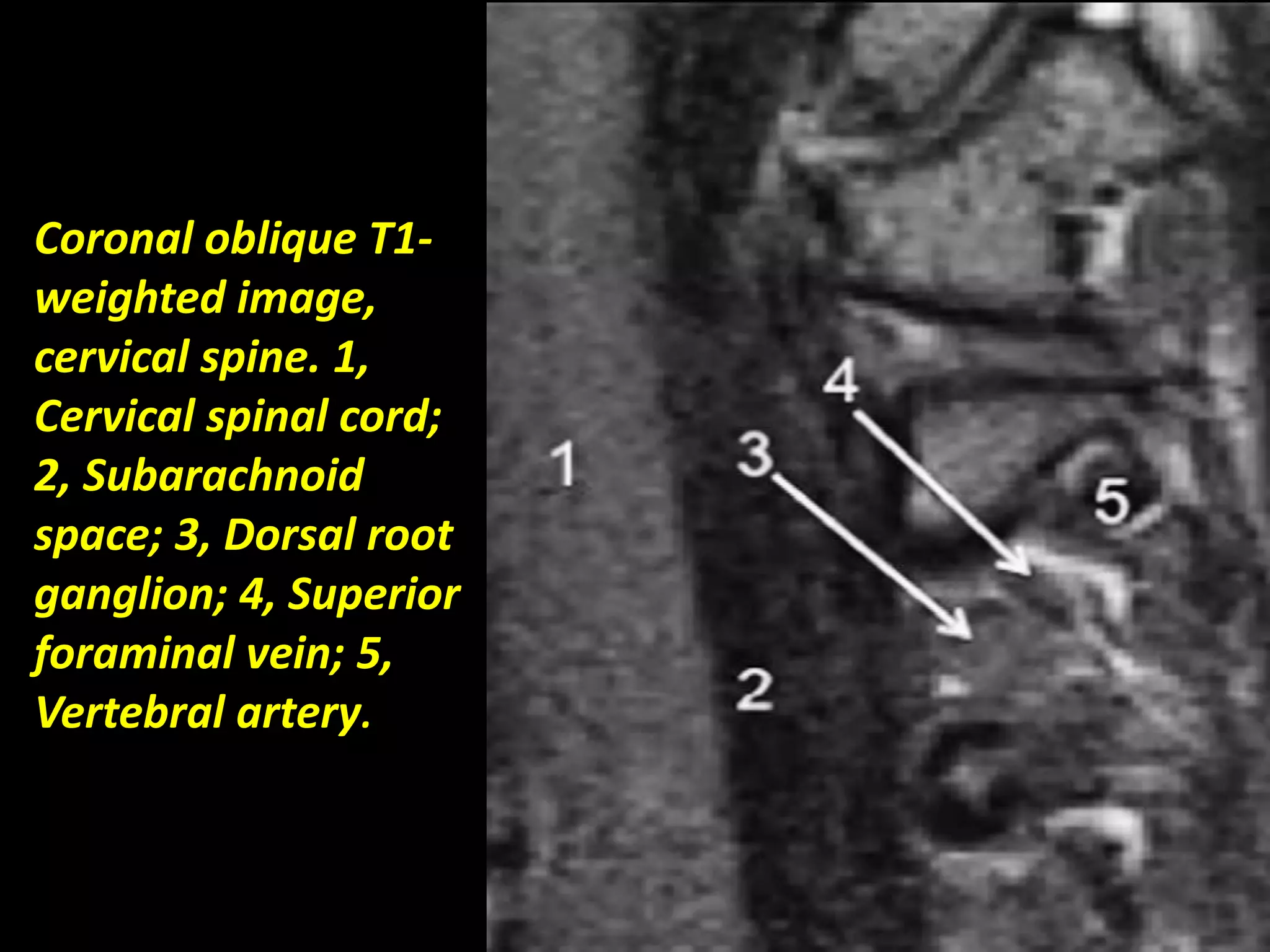 Coronal oblique T1- 
weighted image, 
cervical spine. 1, 
Cervical spinal cord; 
2, Subarachnoid 
space; 3, Dorsal root 
ganglion; 4, Superior 
foraminal vein; 5, 
Vertebral artery. 
 