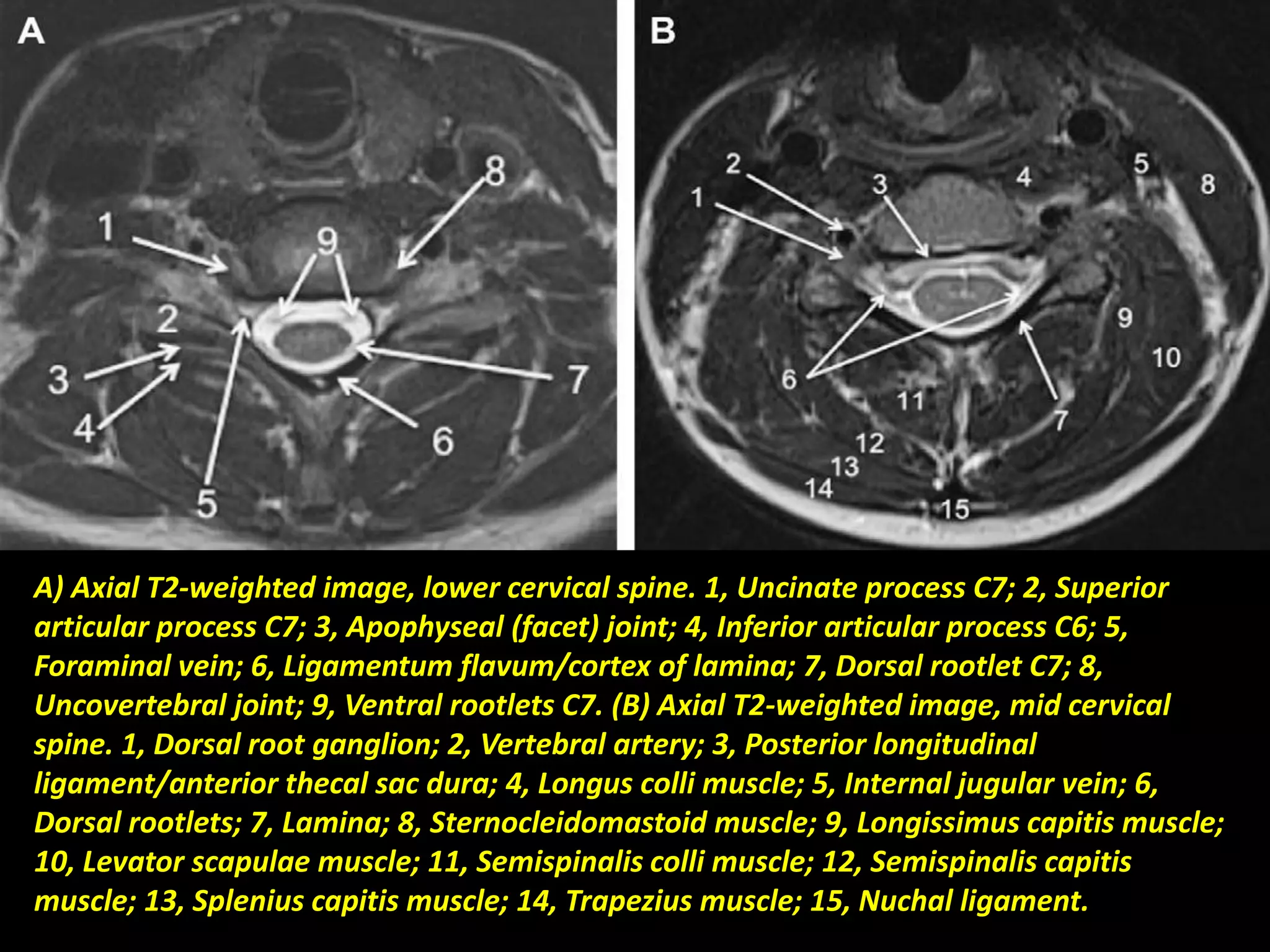 A) Axial T2-weighted image, lower cervical spine. 1, Uncinate process C7; 2, Superior 
articular process C7; 3, Apophyseal (facet) joint; 4, Inferior articular process C6; 5, 
Foraminal vein; 6, Ligamentum flavum/cortex of lamina; 7, Dorsal rootlet C7; 8, 
Uncovertebral joint; 9, Ventral rootlets C7. (B) Axial T2-weighted image, mid cervical 
spine. 1, Dorsal root ganglion; 2, Vertebral artery; 3, Posterior longitudinal 
ligament/anterior thecal sac dura; 4, Longus colli muscle; 5, Internal jugular vein; 6, 
Dorsal rootlets; 7, Lamina; 8, Sternocleidomastoid muscle; 9, Longissimus capitis muscle; 
10, Levator scapulae muscle; 11, Semispinalis colli muscle; 12, Semispinalis capitis 
muscle; 13, Splenius capitis muscle; 14, Trapezius muscle; 15, Nuchal ligament. 
 