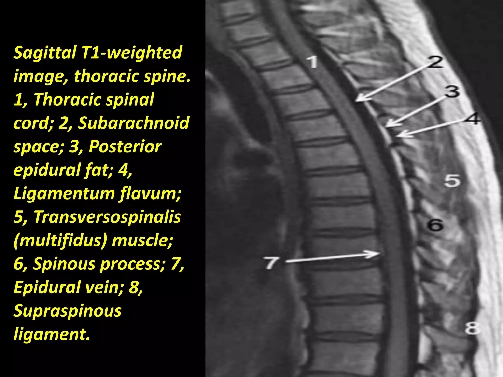 Sagittal T1-weighted 
image, thoracic spine. 
1, Thoracic spinal 
cord; 2, Subarachnoid 
space; 3, Posterior 
epidural fat; 4, 
Ligamentum flavum; 
5, Transversospinalis 
(multifidus) muscle; 
6, Spinous process; 7, 
Epidural vein; 8, 
Supraspinous 
ligament.. 
 