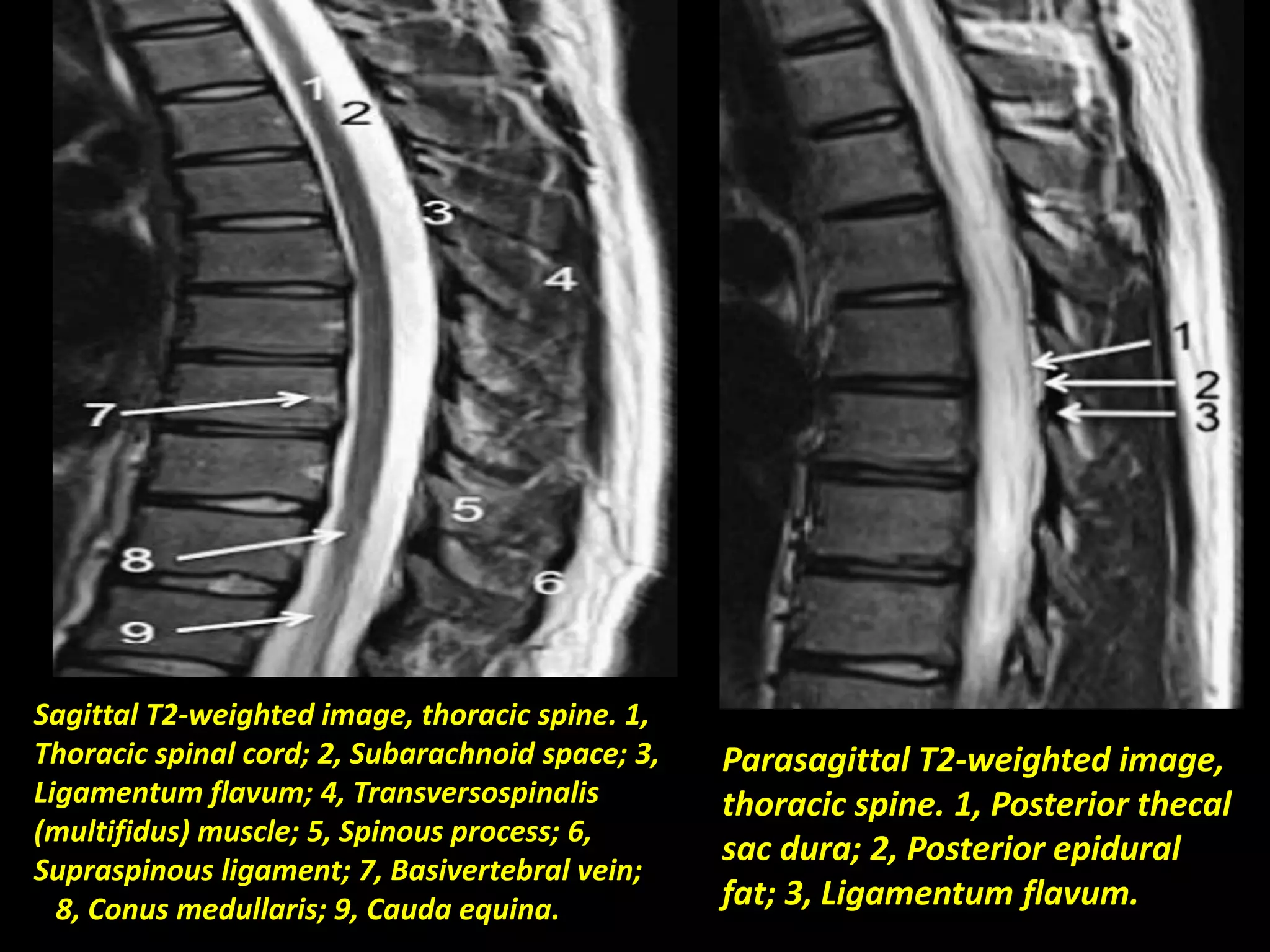 Parasagittal T2-weighted image, 
thoracic spine. 1, Posterior thecal 
sac dura; 2, Posterior epidural 
fat; 3, Ligamentum flavum. 
Sagittal T2-weighted image, thoracic spine. 1, 
Thoracic spinal cord; 2, Subarachnoid space; 3, 
Ligamentum flavum; 4, Transversospinalis 
(multifidus) muscle; 5, Spinous process; 6, 
Supraspinous ligament; 7, Basivertebral vein; 
8, Conus medullaris; 9, Cauda equina. 
 