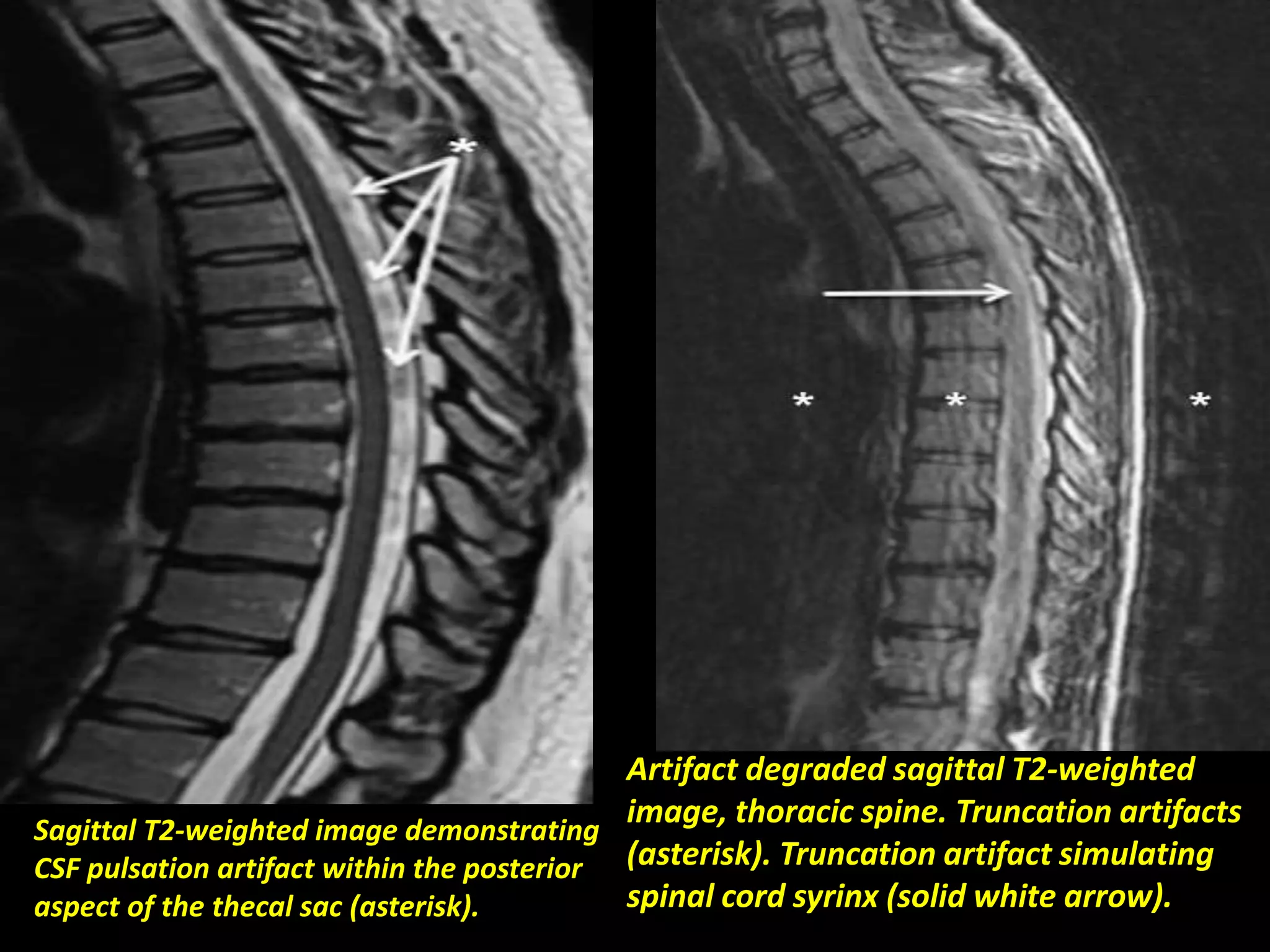 Sagittal T2-weighted image demonstrating 
CSF pulsation artifact within the posterior 
aspect of the thecal sac (asterisk). 
Artifact degraded sagittal T2-weighted 
image, thoracic spine. Truncation artifacts 
(asterisk). Truncation artifact simulating 
spinal cord syrinx (solid white arrow). 
 