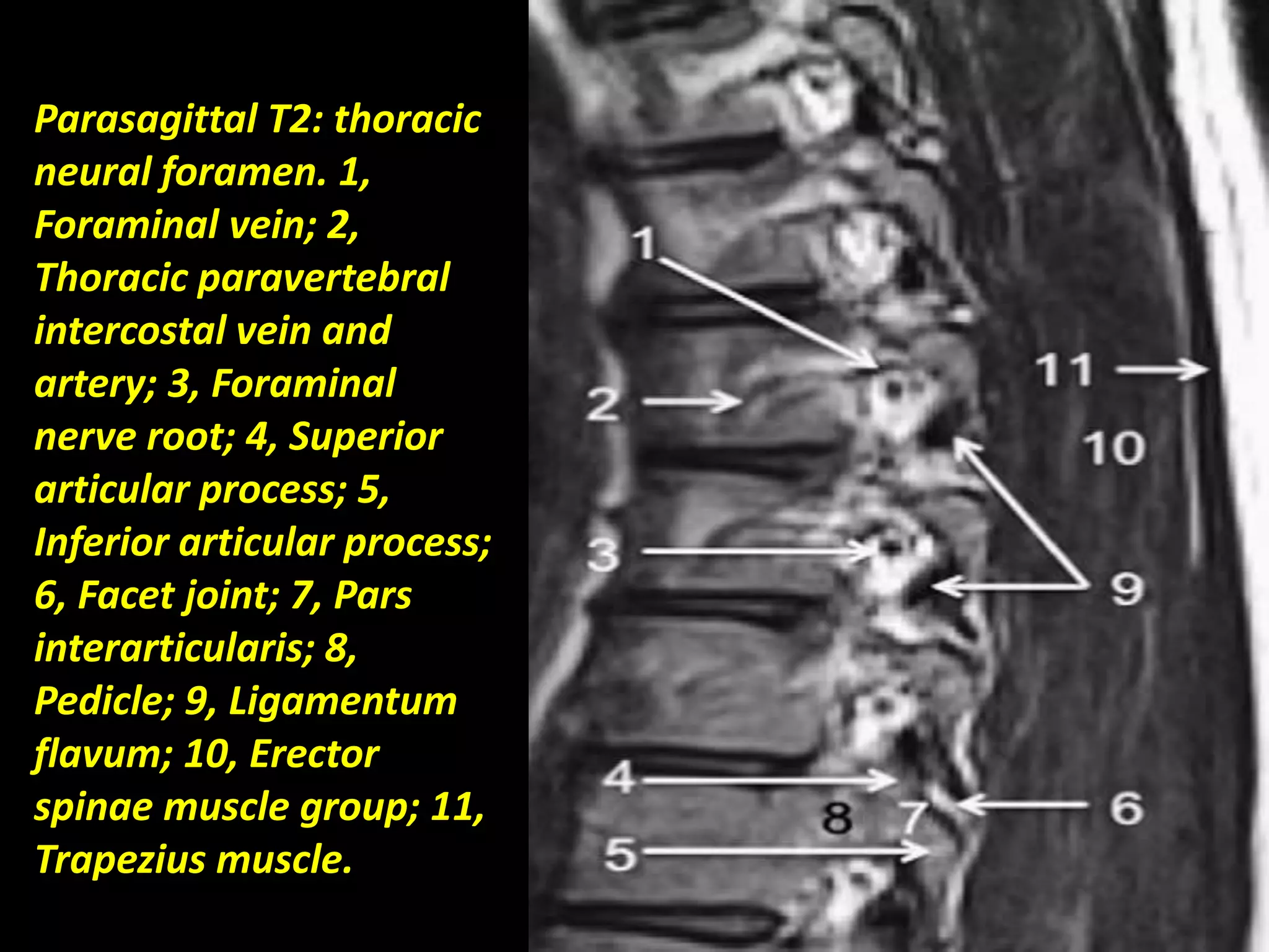 Parasagittal T2: thoracic 
neural foramen. 1, 
Foraminal vein; 2, 
Thoracic paravertebral 
intercostal vein and 
artery; 3, Foraminal 
nerve root; 4, Superior 
articular process; 5, 
Inferior articular process; 
6, Facet joint; 7, Pars 
interarticularis; 8, 
Pedicle; 9, Ligamentum 
flavum; 10, Erector 
spinae muscle group; 11, 
Trapezius muscle. 
 