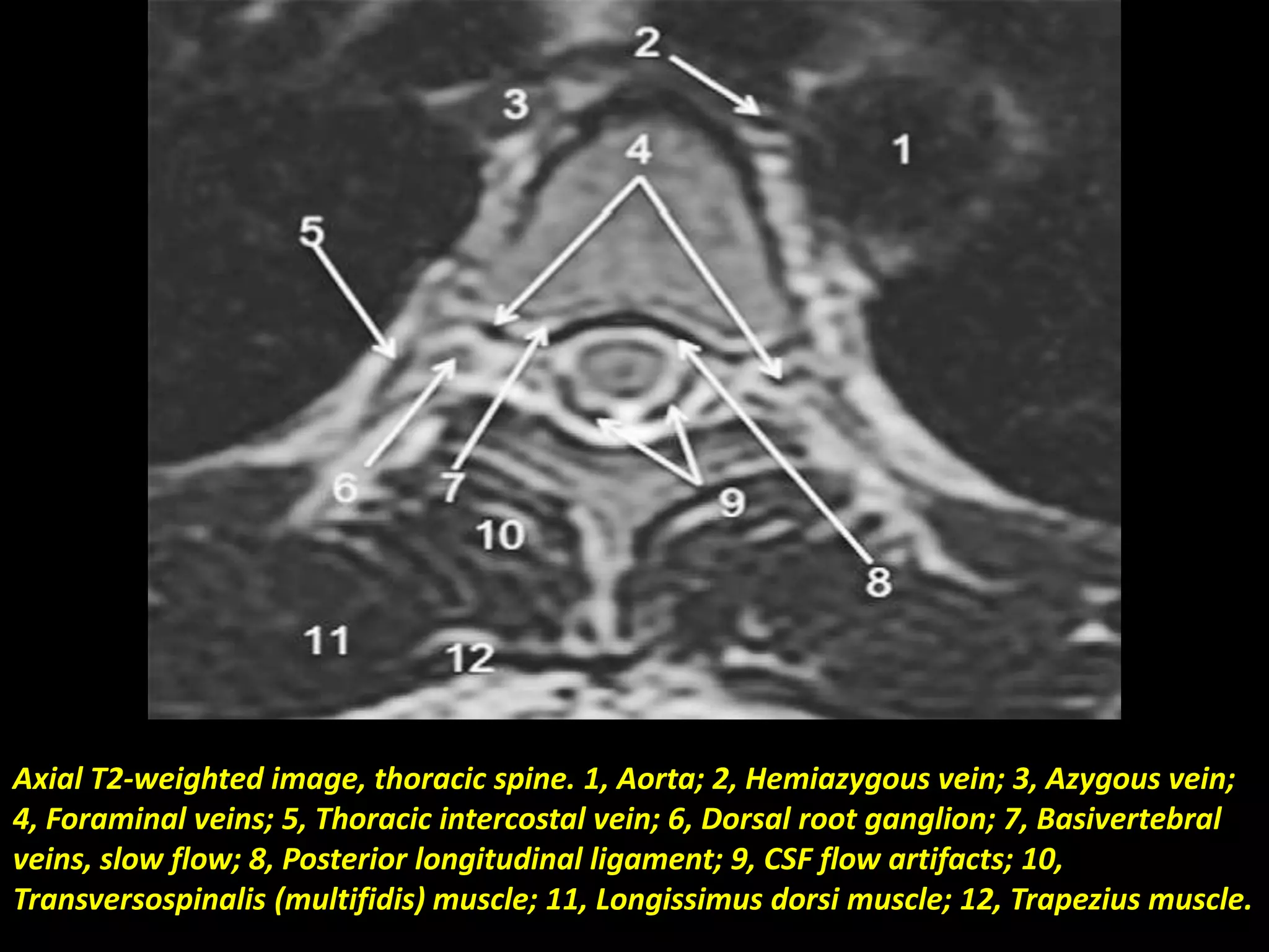 Axial T2-weighted image, thoracic spine. 1, Aorta; 2, Hemiazygous vein; 3, Azygous vein; 
4, Foraminal veins; 5, Thoracic intercostal vein; 6, Dorsal root ganglion; 7, Basivertebral 
veins, slow flow; 8, Posterior longitudinal ligament; 9, CSF flow artifacts; 10, 
Transversospinalis (multifidis) muscle; 11, Longissimus dorsi muscle; 12, Trapezius muscle. 
 