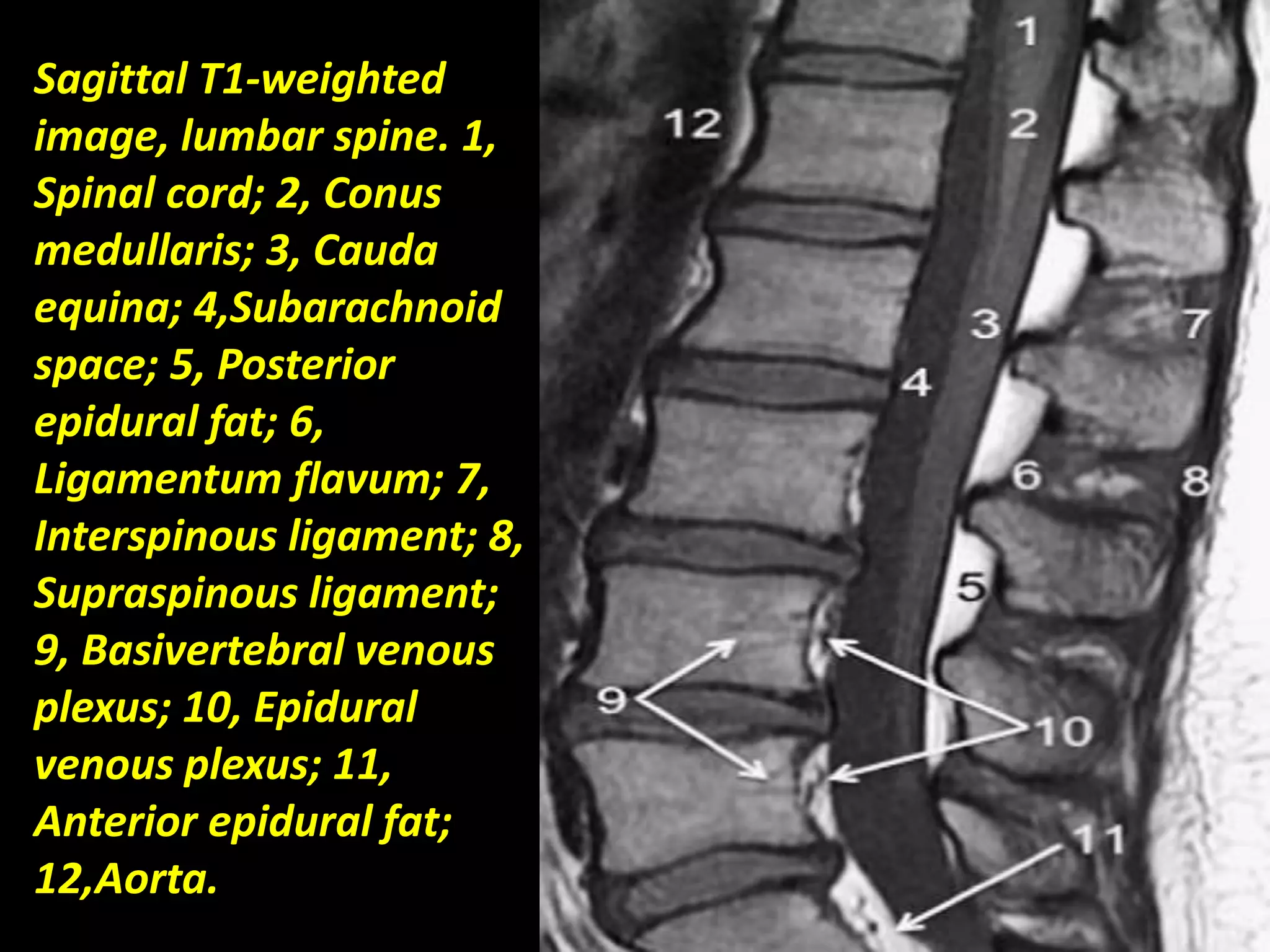 Sagittal T1-weighted 
image, lumbar spine. 1, 
Spinal cord; 2, Conus 
medullaris; 3, Cauda 
equina; 4,Subarachnoid 
space; 5, Posterior 
epidural fat; 6, 
Ligamentum flavum; 7, 
Interspinous ligament; 8, 
Supraspinous ligament; 
9, Basivertebral venous 
plexus; 10, Epidural 
venous plexus; 11, 
Anterior epidural fat; 
12,Aorta. 
 
