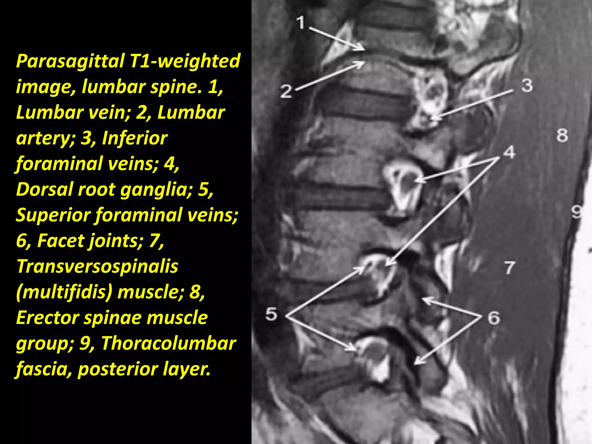 Parasagittal T1-weighted 
image, lumbar spine. 1, 
Lumbar vein; 2, Lumbar 
artery; 3, Inferior 
foraminal veins; 4, 
Dorsal root ganglia; 5, 
Superior foraminal veins; 
6, Facet joints; 7, 
Transversospinalis 
(multifidis) muscle; 8, 
Erector spinae muscle 
group; 9, Thoracolumbar 
fascia, posterior layer. 
 