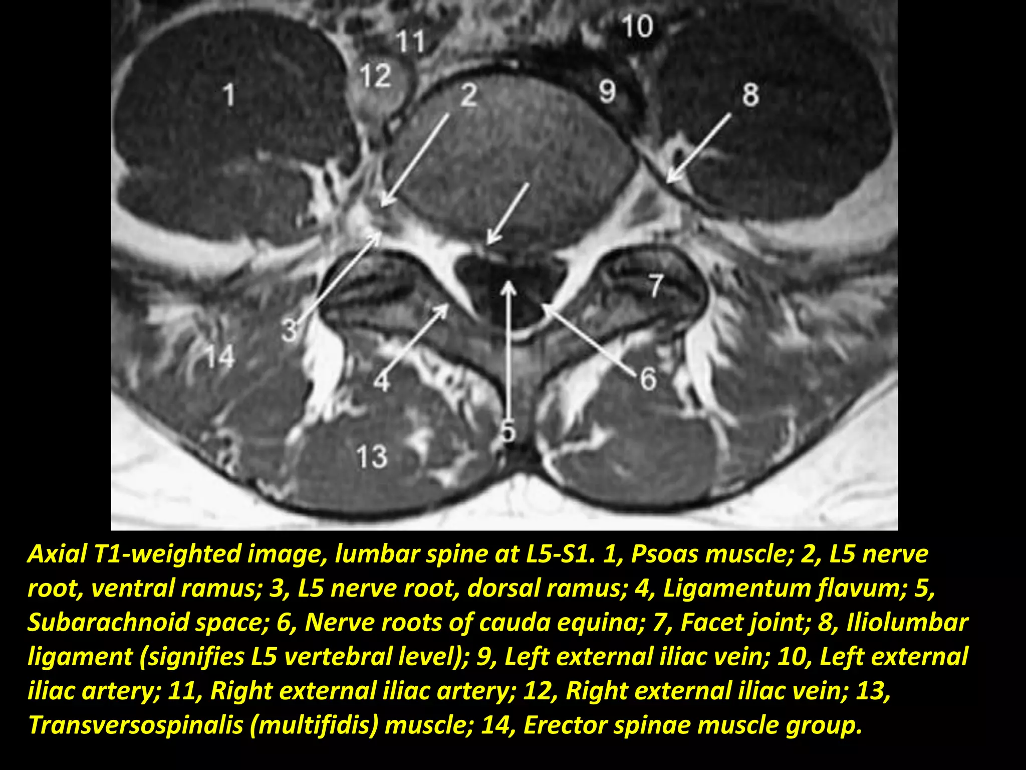 Axial T1-weighted image, lumbar spine at L5-S1. 1, Psoas muscle; 2, L5 nerve 
root, ventral ramus; 3, L5 nerve root, dorsal ramus; 4, Ligamentum flavum; 5, 
Subarachnoid space; 6, Nerve roots of cauda equina; 7, Facet joint; 8, Iliolumbar 
ligament (signifies L5 vertebral level); 9, Left external iliac vein; 10, Left external 
iliac artery; 11, Right external iliac artery; 12, Right external iliac vein; 13, 
Transversospinalis (multifidis) muscle; 14, Erector spinae muscle group. 
 